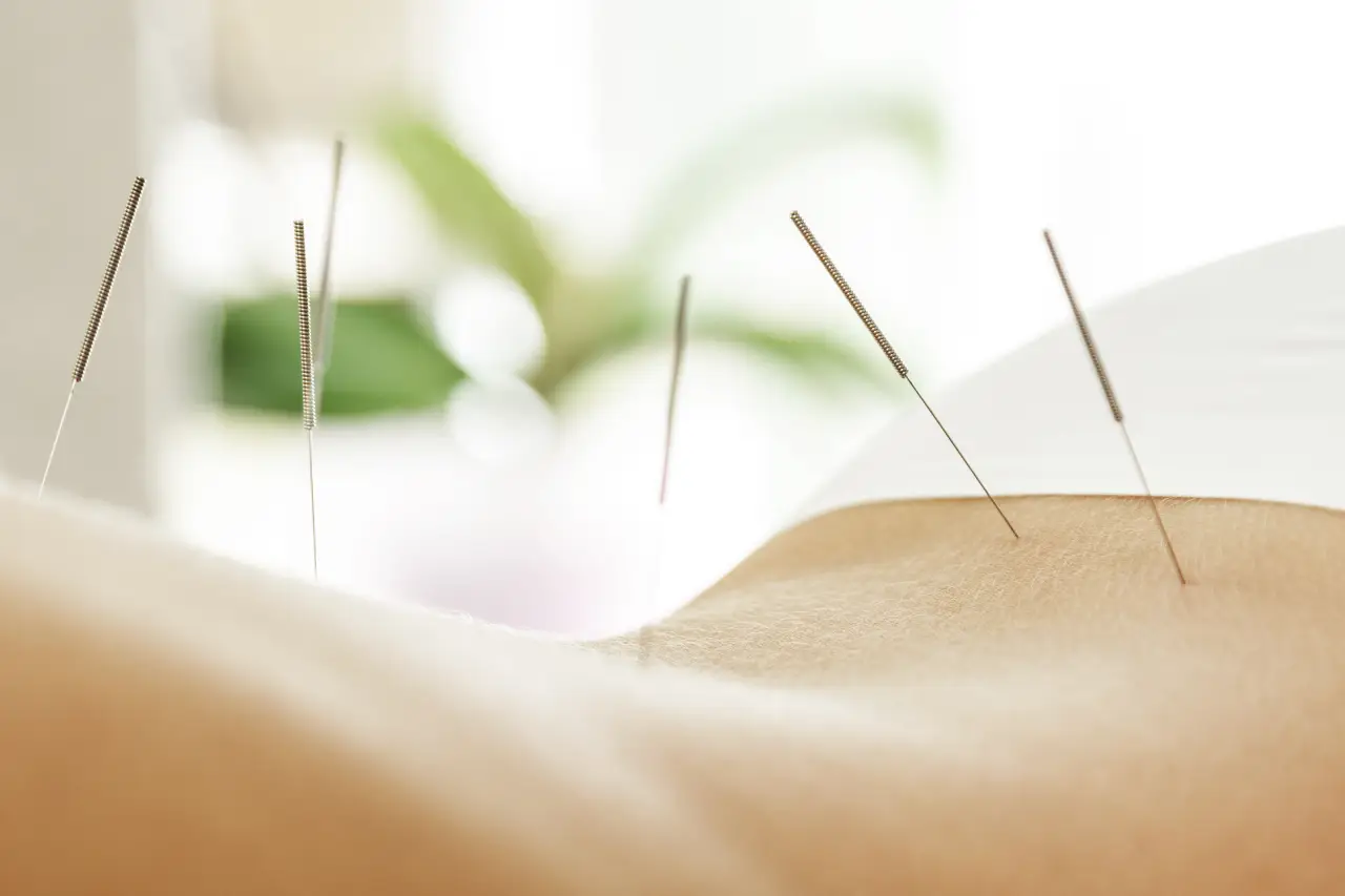 acupuncture needs