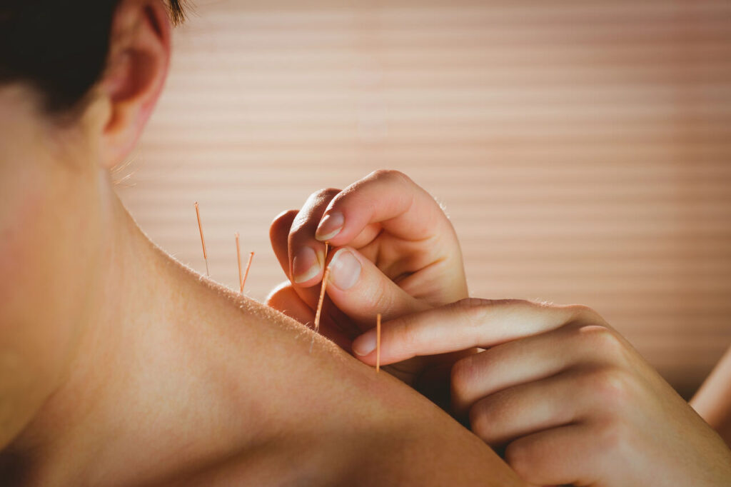 acupuncture benefits