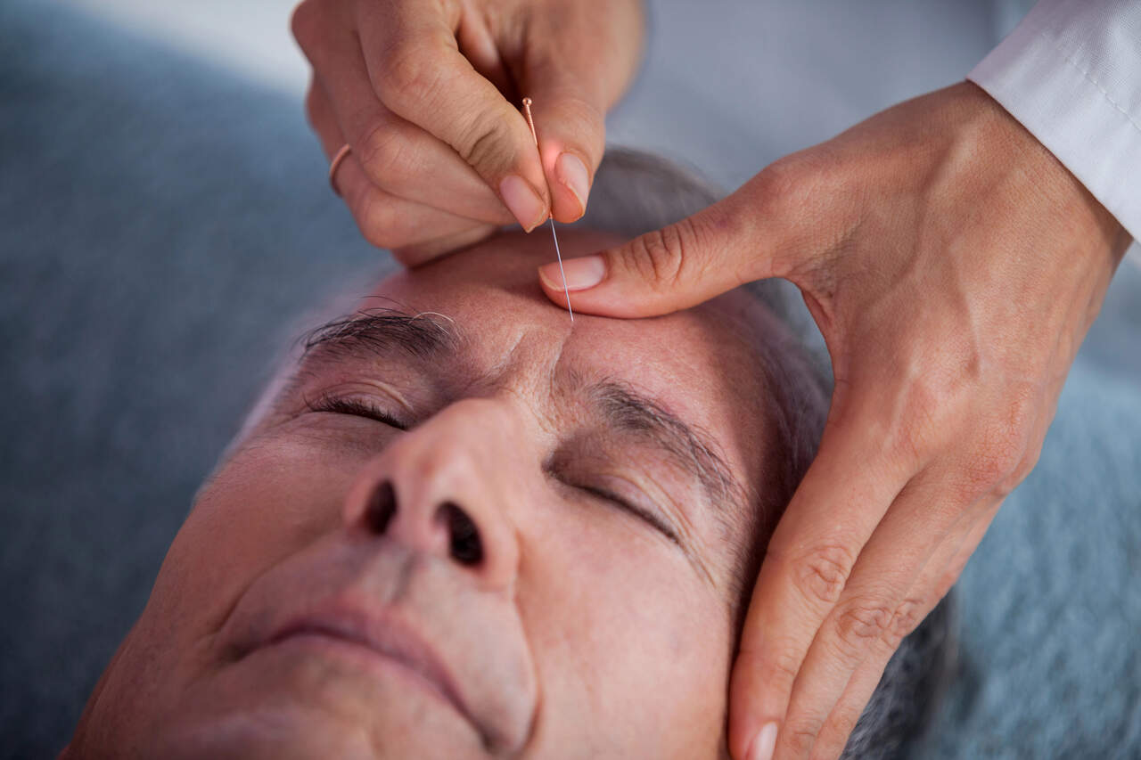 Migraine Miracle: How Acupuncture Can Ease Your Pain