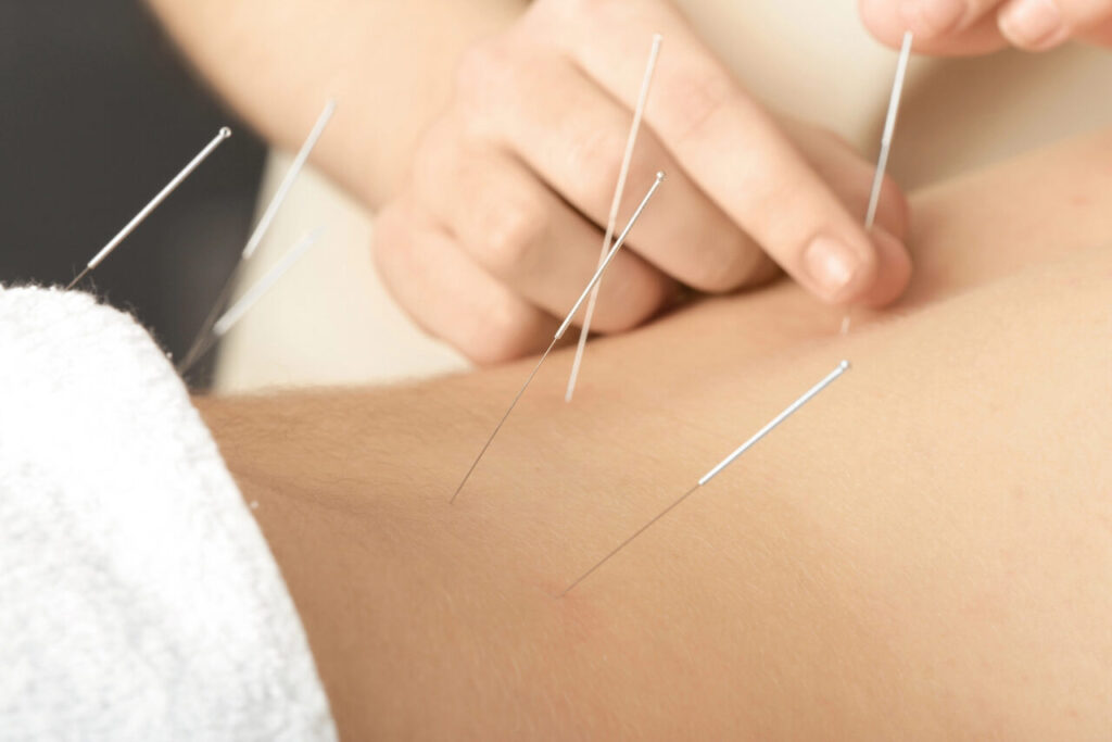 acupuncture for back pain