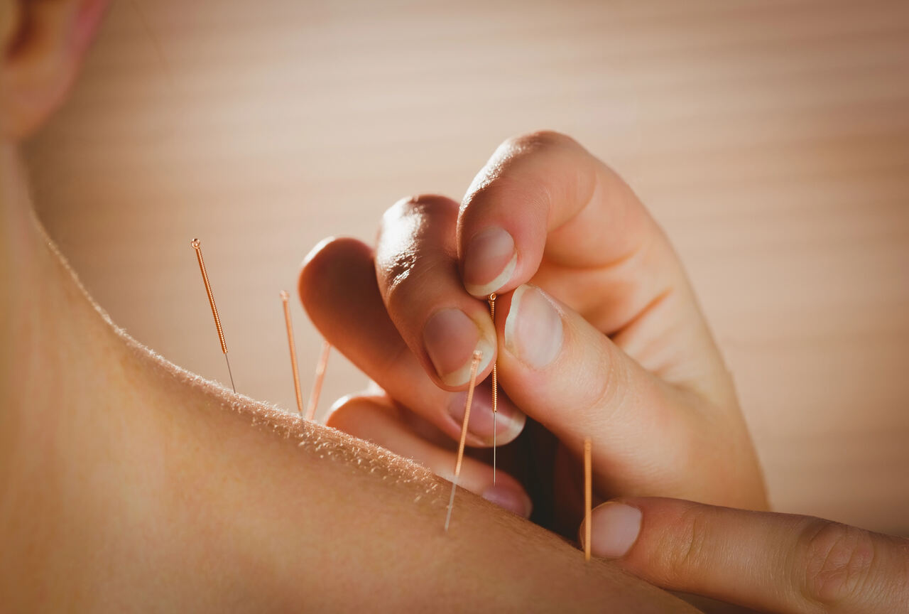 Unlocking the Healing Benefits: Acupuncture for Neck Pain